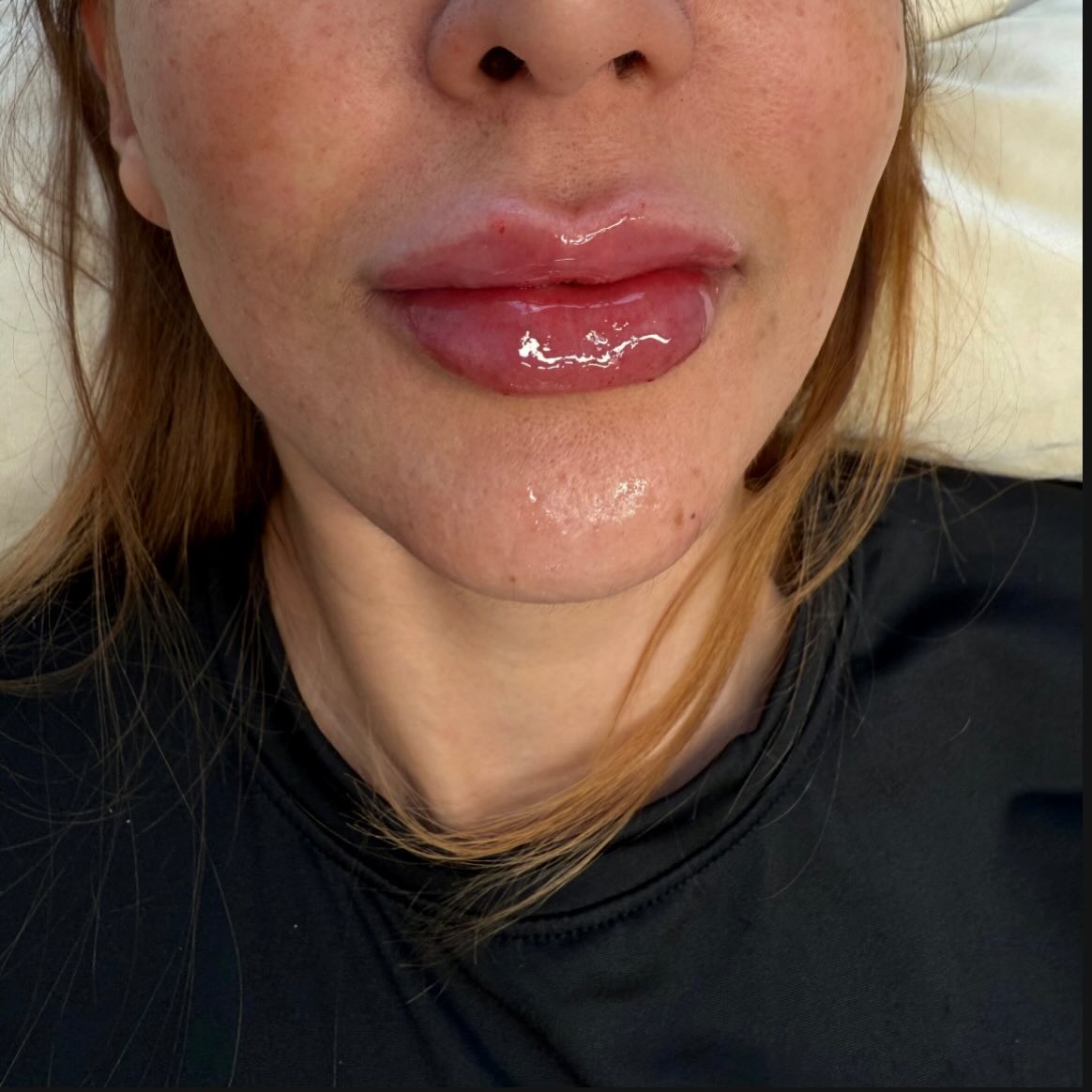 Skinbooster — hidratação