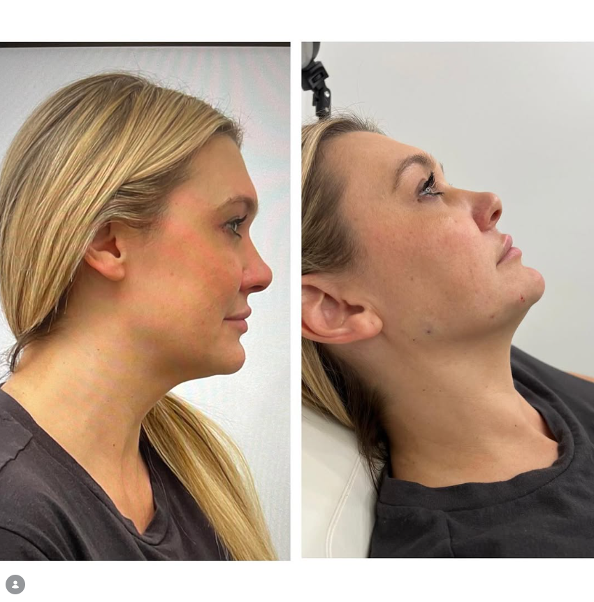 Before and after result at Shoreline Aesthetics, Charleston