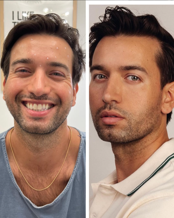 Before and after result at Shoreline Aesthetics, Charleston