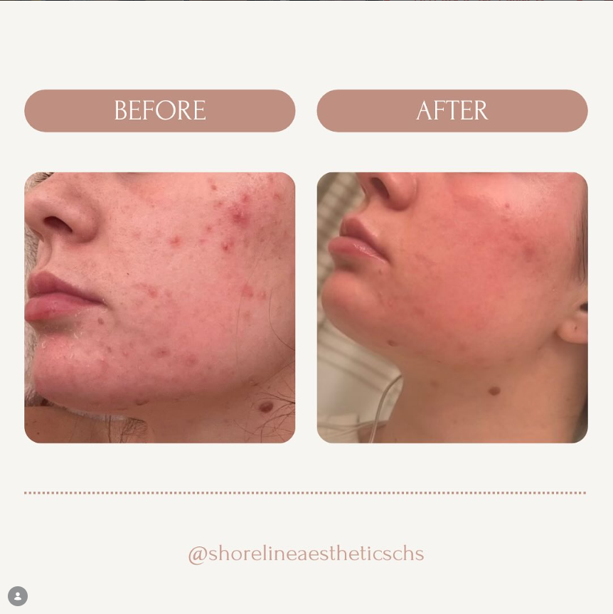 Before and after result at Shoreline Aesthetics, Charleston