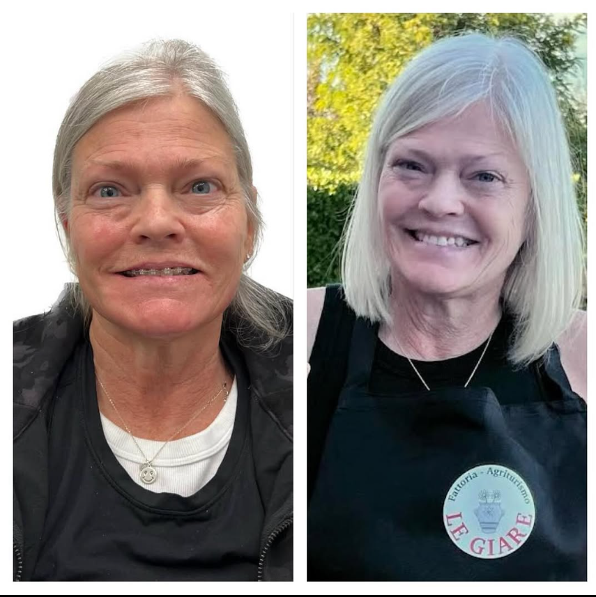 Before and after result at Shoreline Aesthetics, Charleston