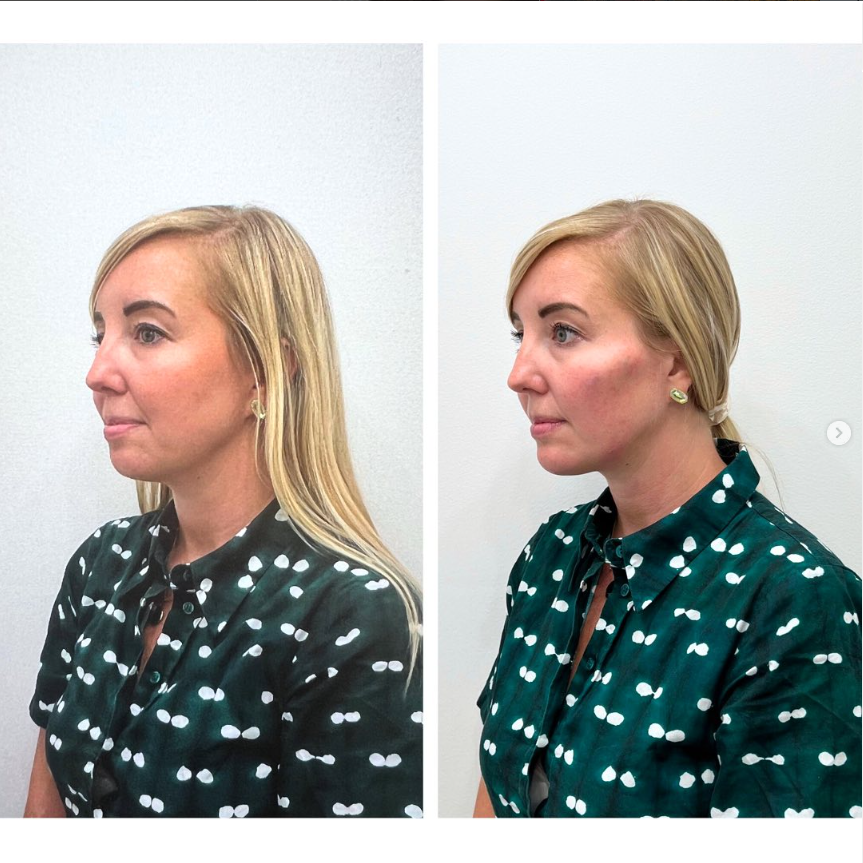 Before and after result at Shoreline Aesthetics, Charleston