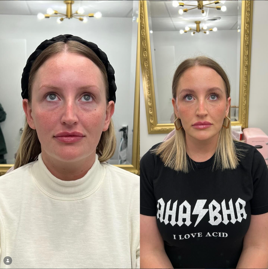 Before and after result at Shoreline Aesthetics, Charleston