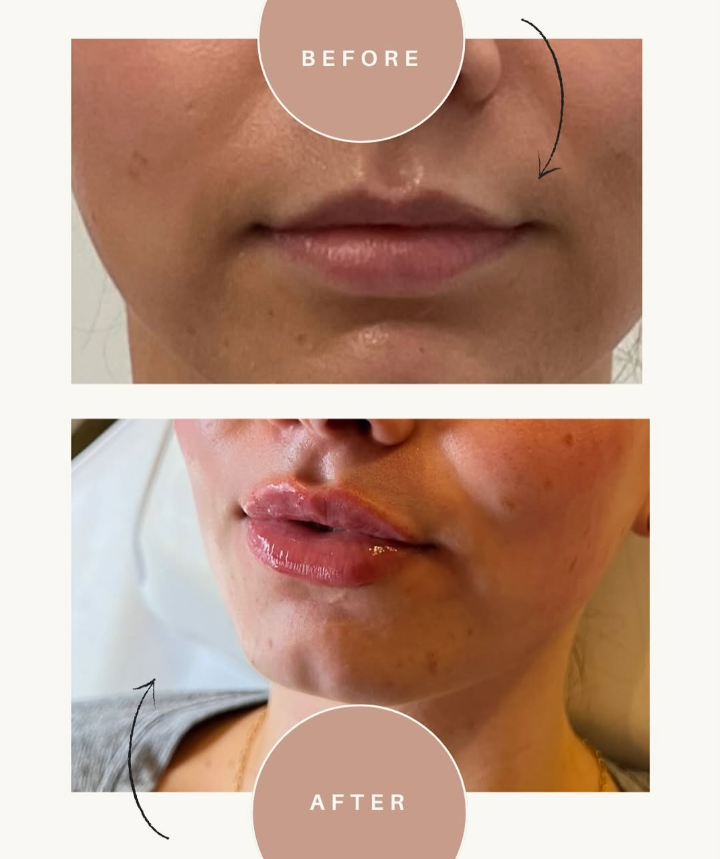Before and after result at Shoreline Aesthetics, Charleston