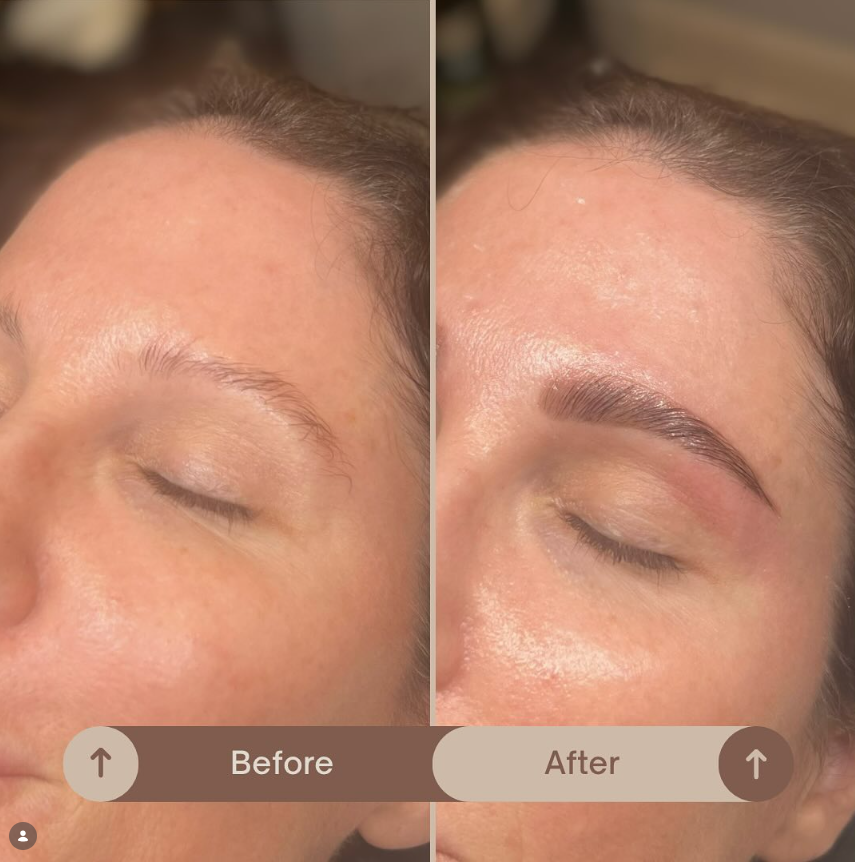 Before and after result at Shoreline Aesthetics, Charleston