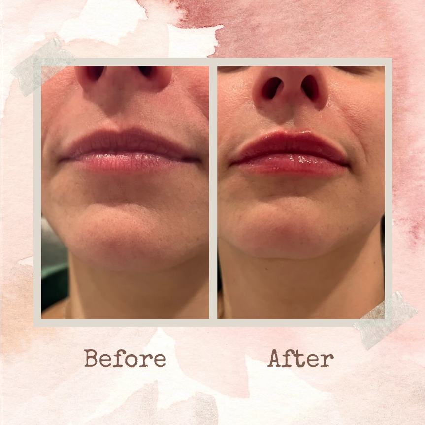 Before and after result at Shoreline Aesthetics, Charleston