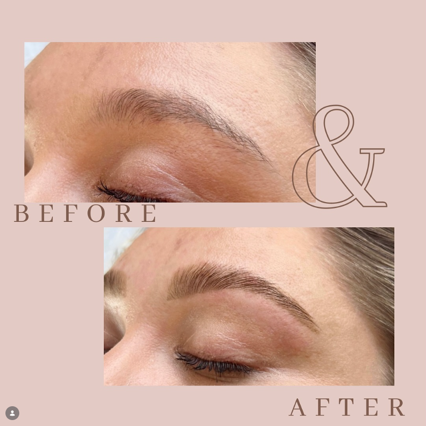 Before and after result at Shoreline Aesthetics, Charleston