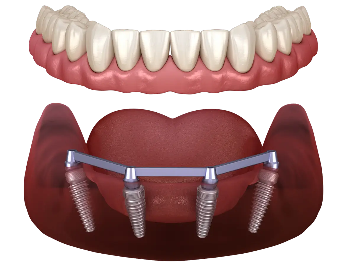 Dental implants frequently asked questions