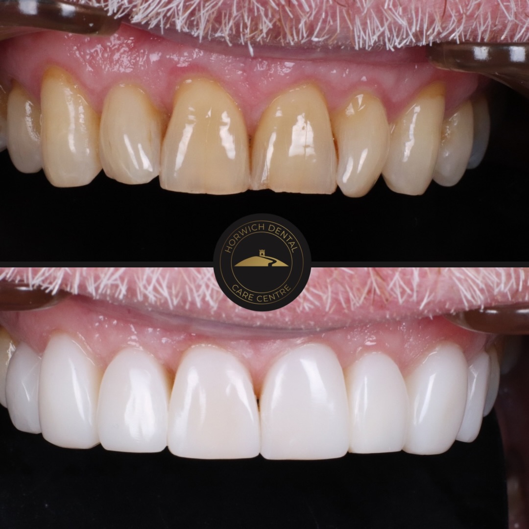 Teeth whitening result 1