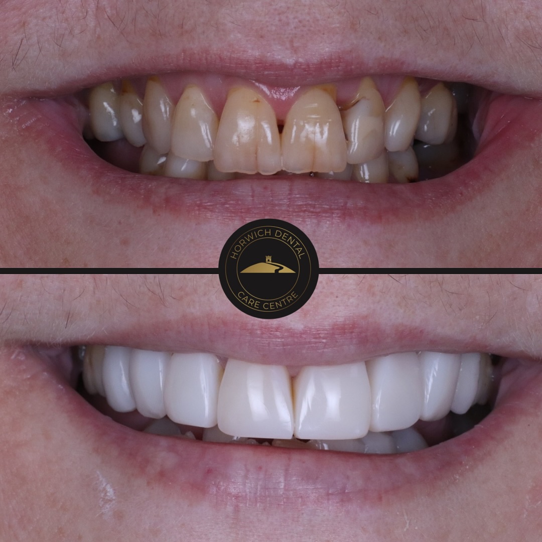 Teeth whitening result 2