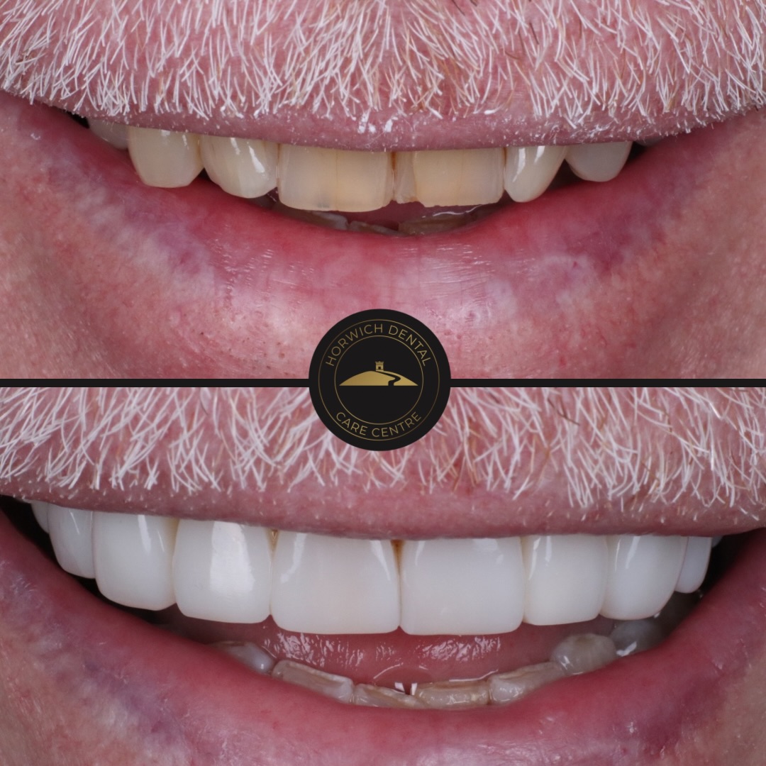 Teeth whitening result 4
