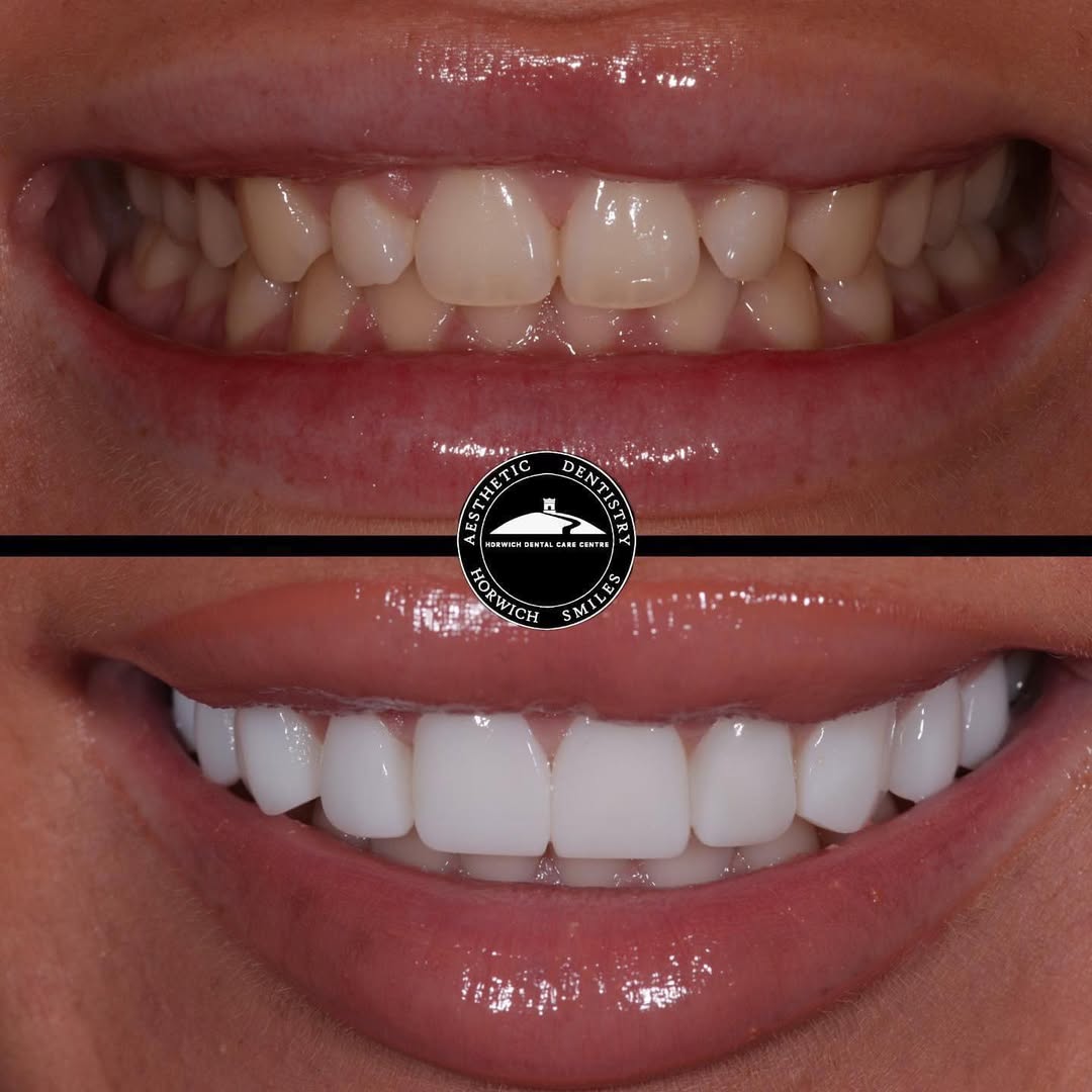 Professional teeth whitening at Horwich Dental Care Centre