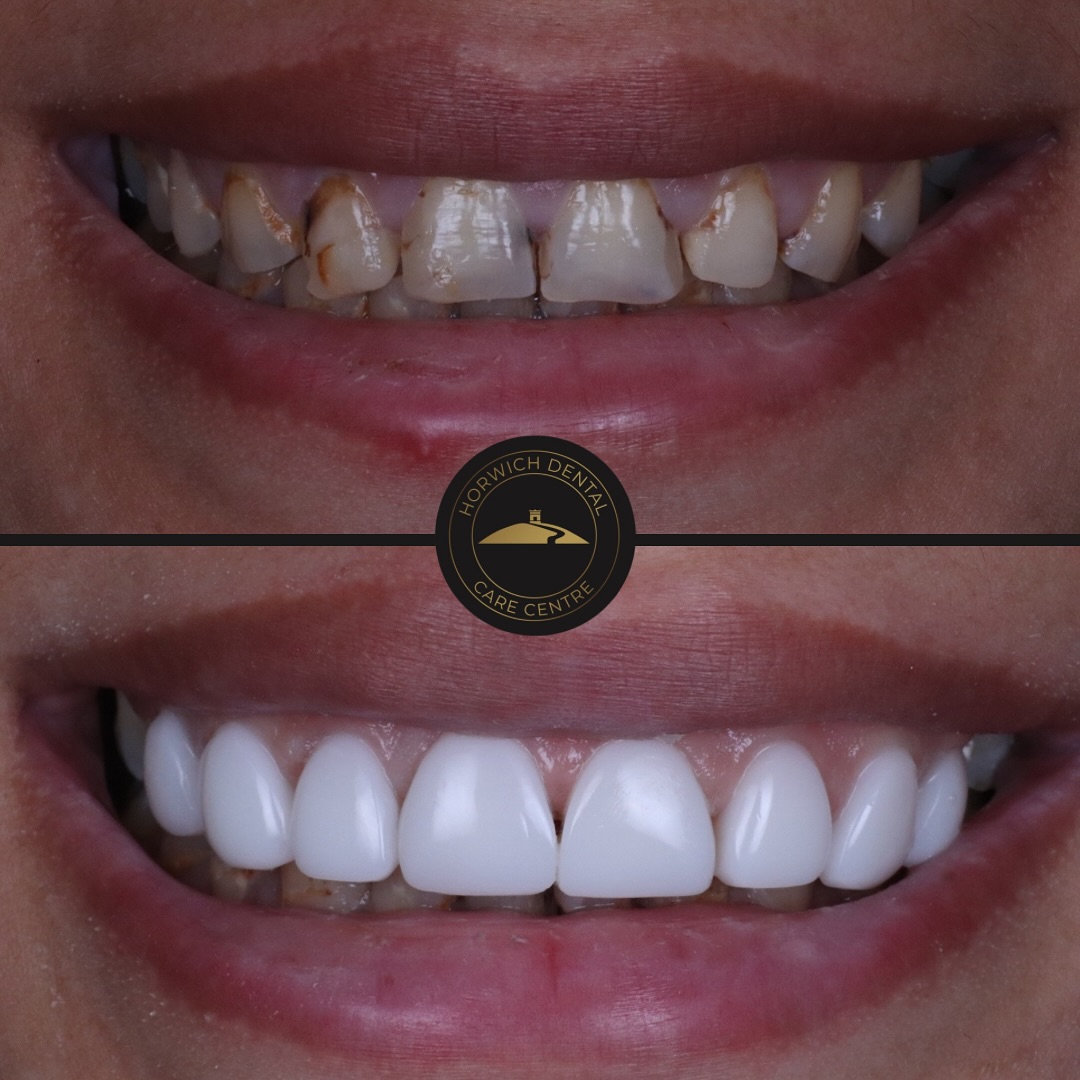 Teeth whitening result 3