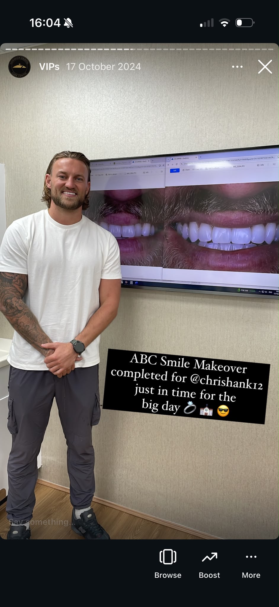 Patient after full arch dental implant treatment