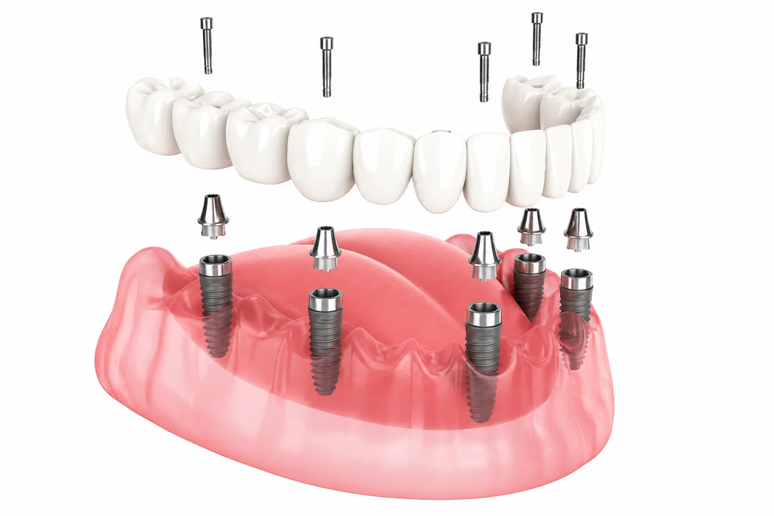 All-on-6 dental implant illustration