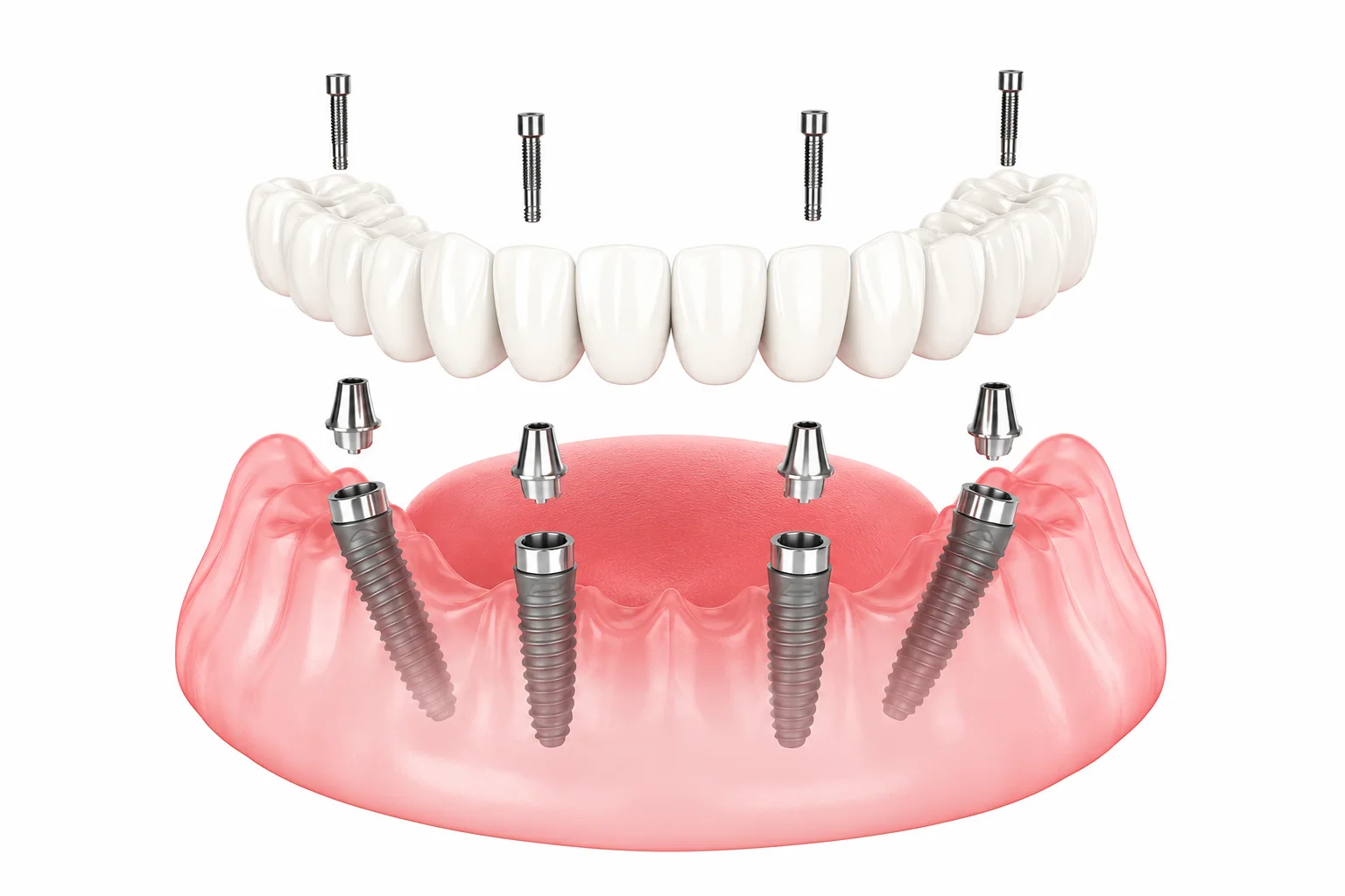 All-on-4 dental implant illustration