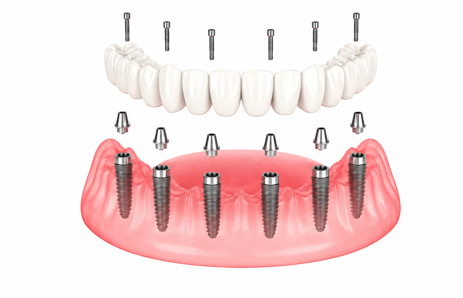 All-on-6 dental implant illustration
