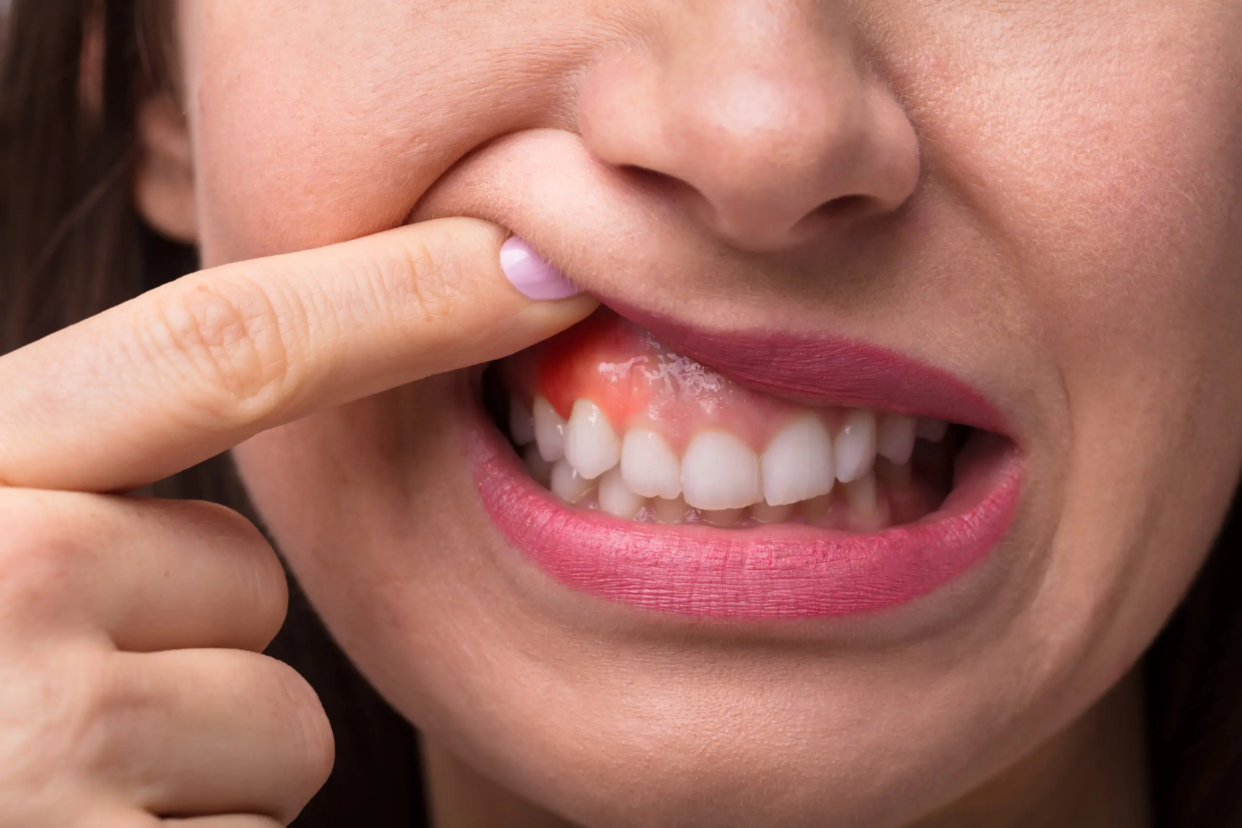 Dental infection