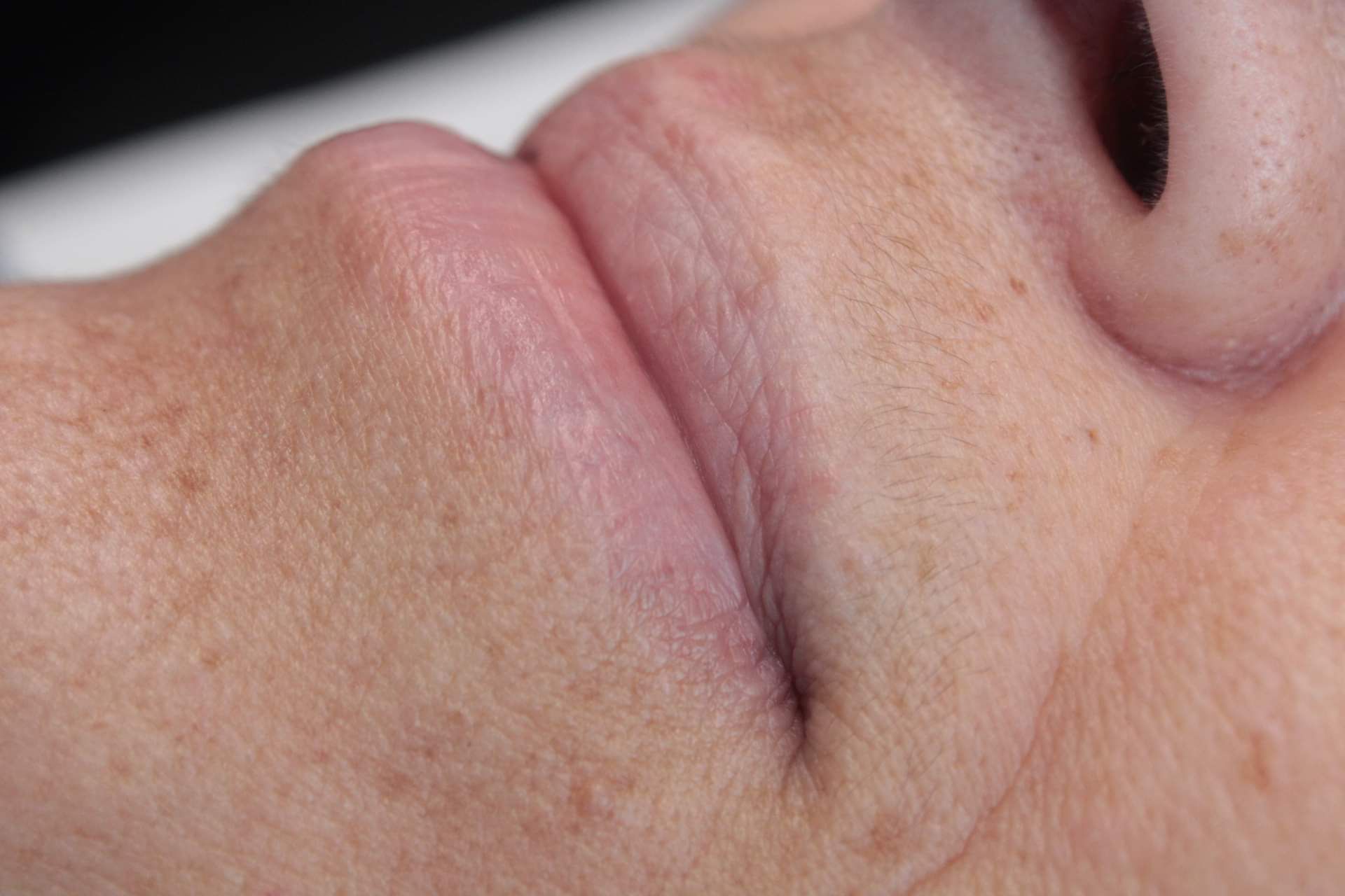 Avant — Micropigmentation des lèvres