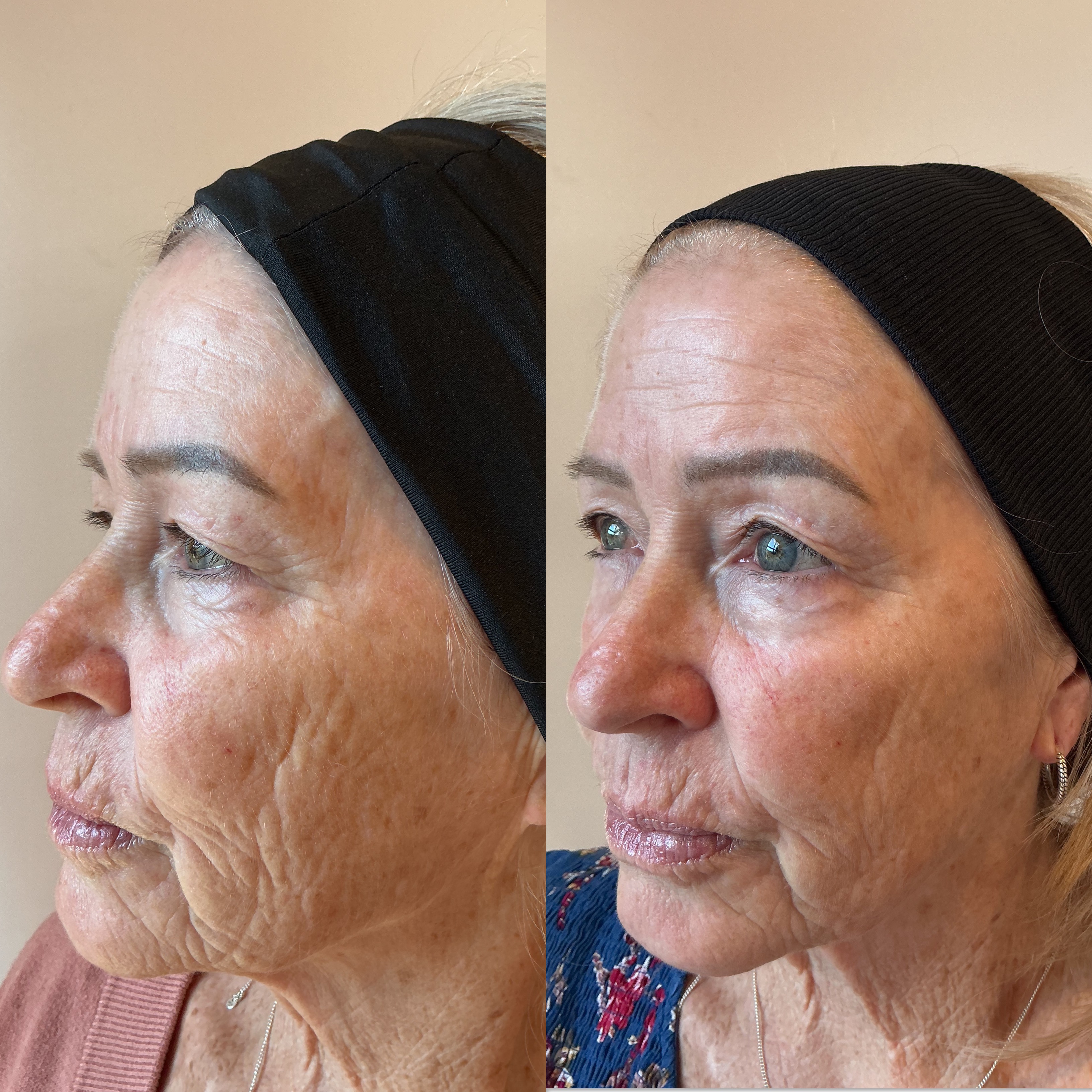 Carbon Facial before and after