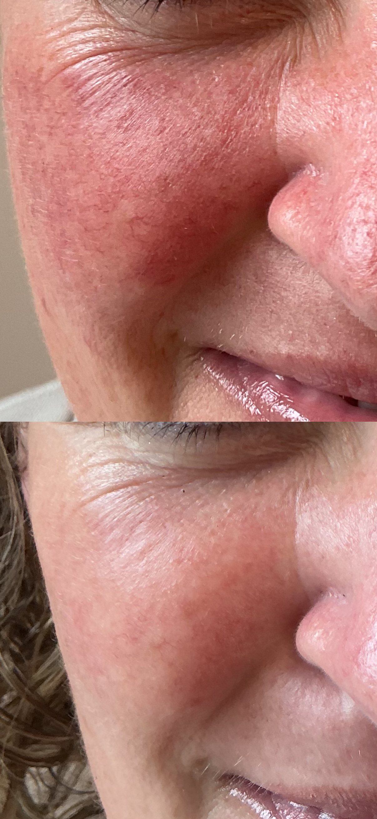 Carbon Facial before and after