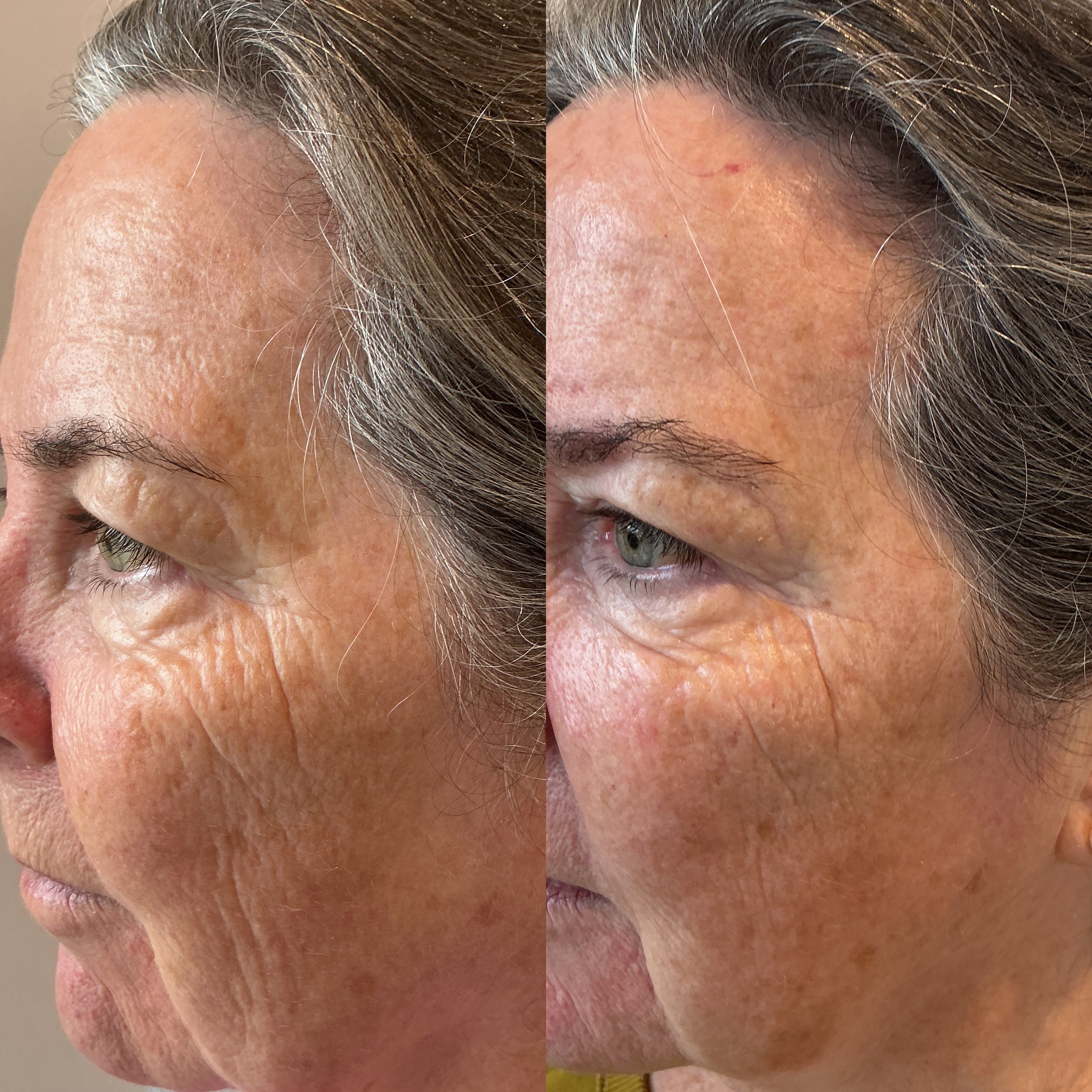 Carbon Facial before and after
