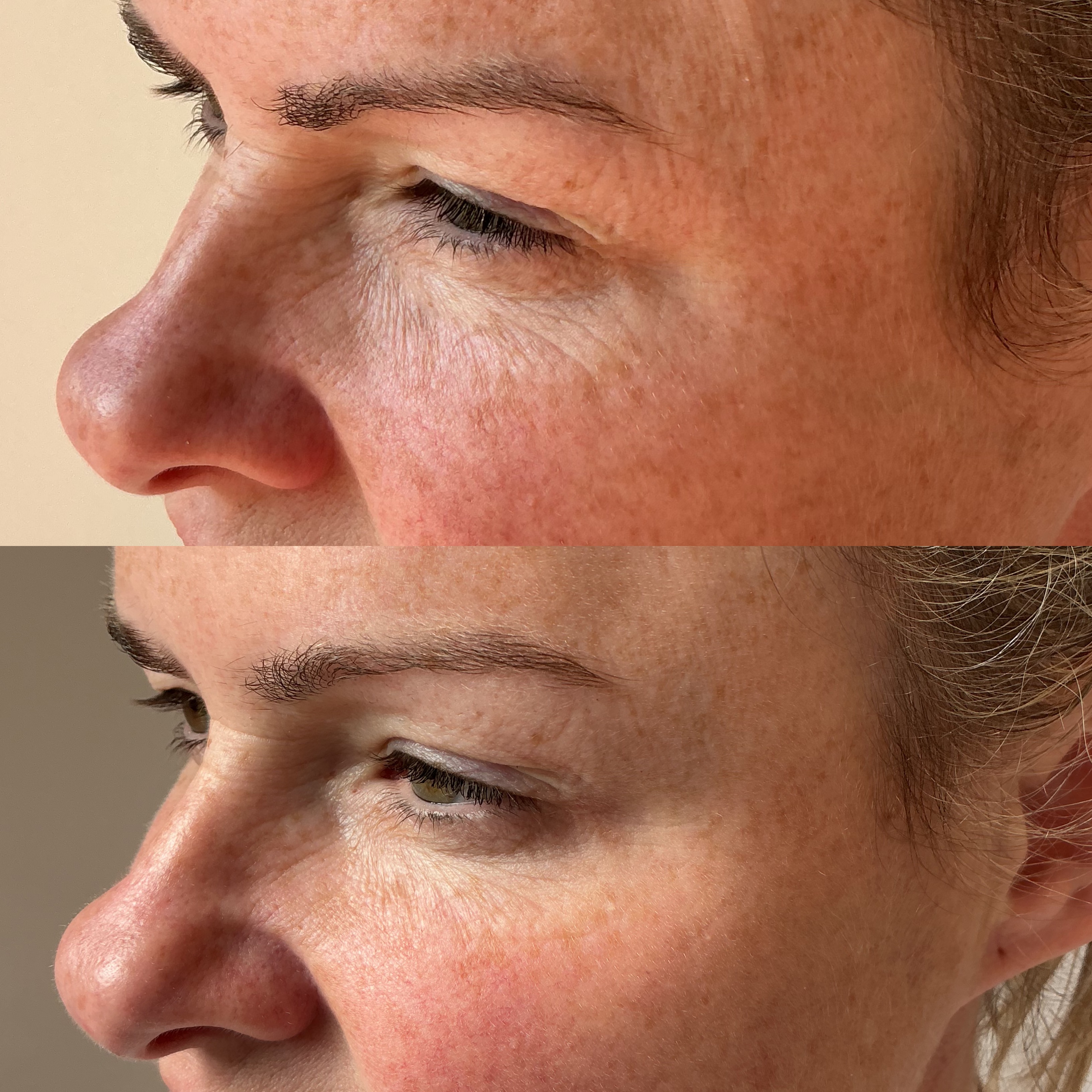 Carbon Facial before and after