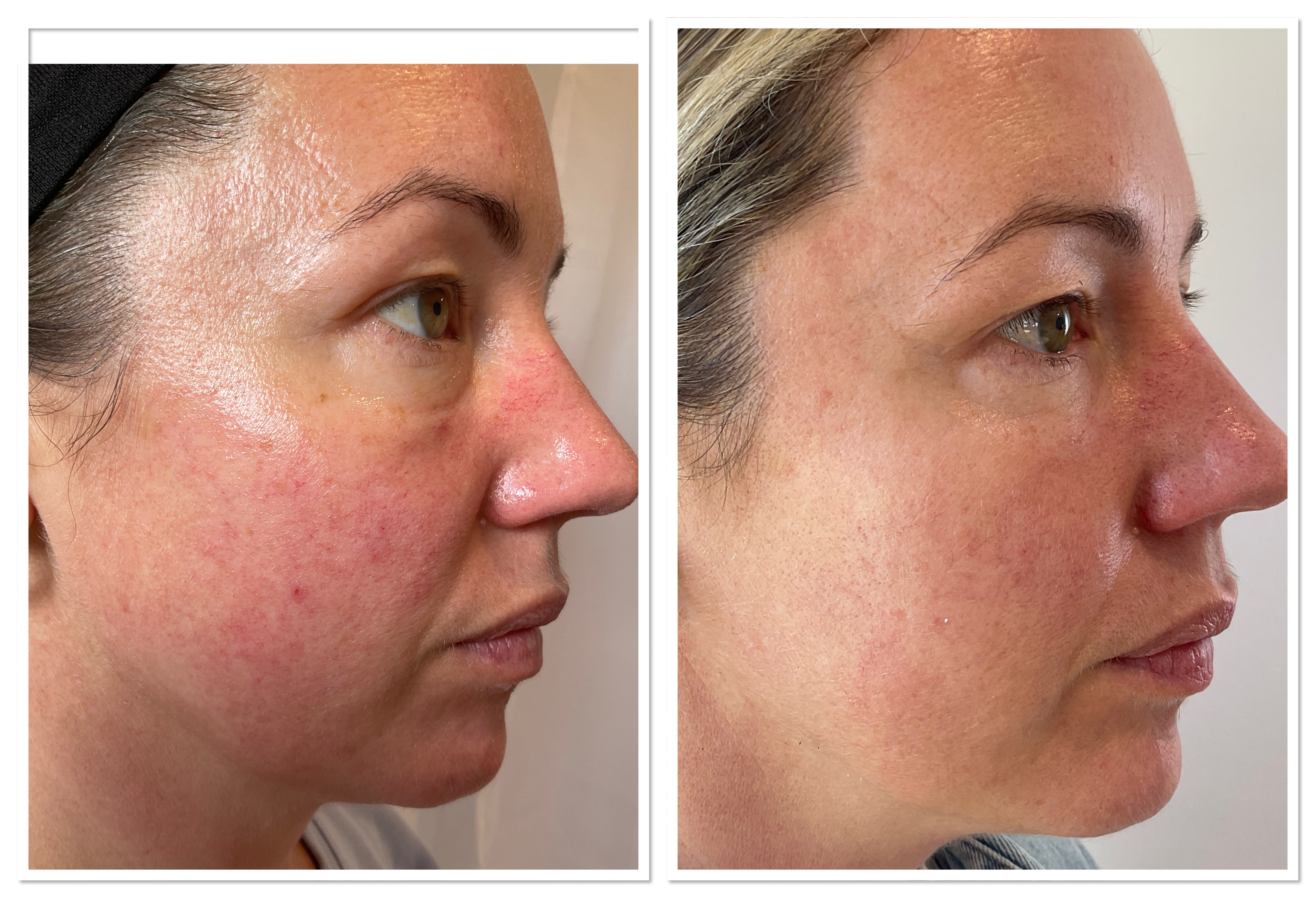 Carbon Facial before and after