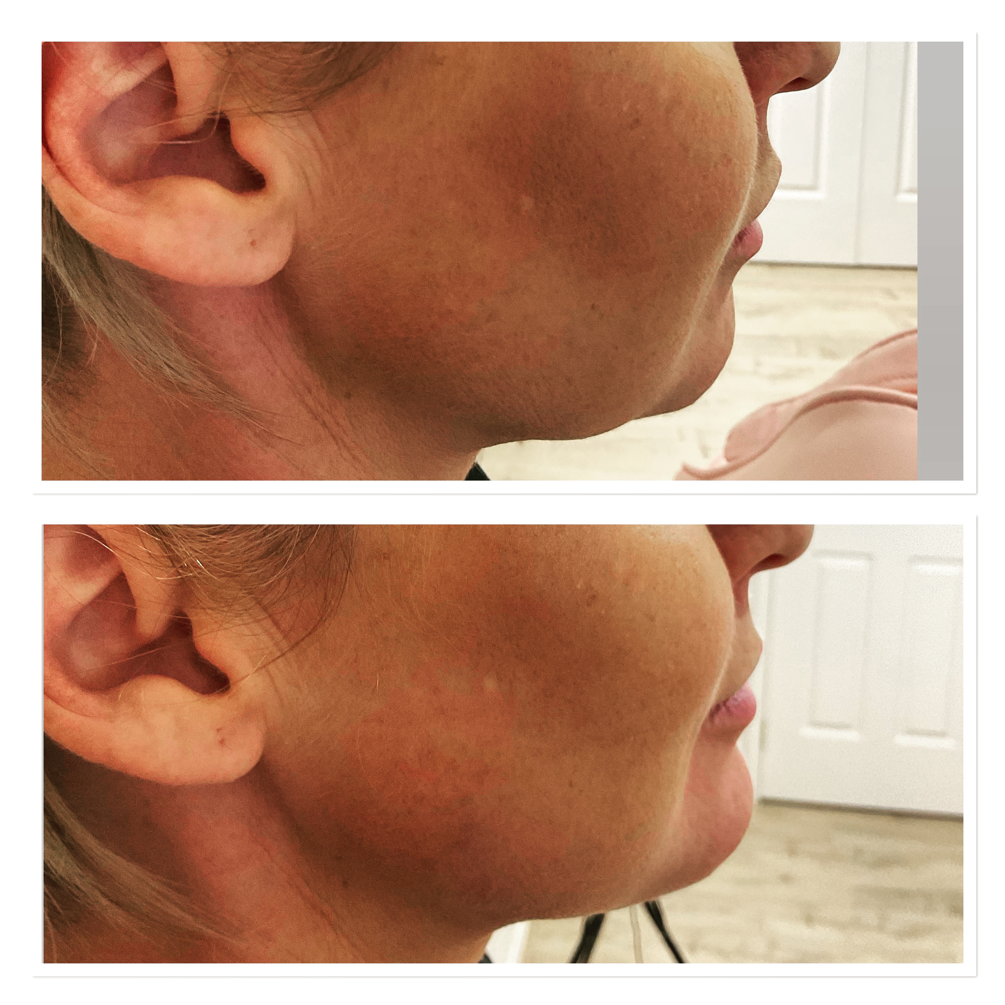 Carbon Facial before and after