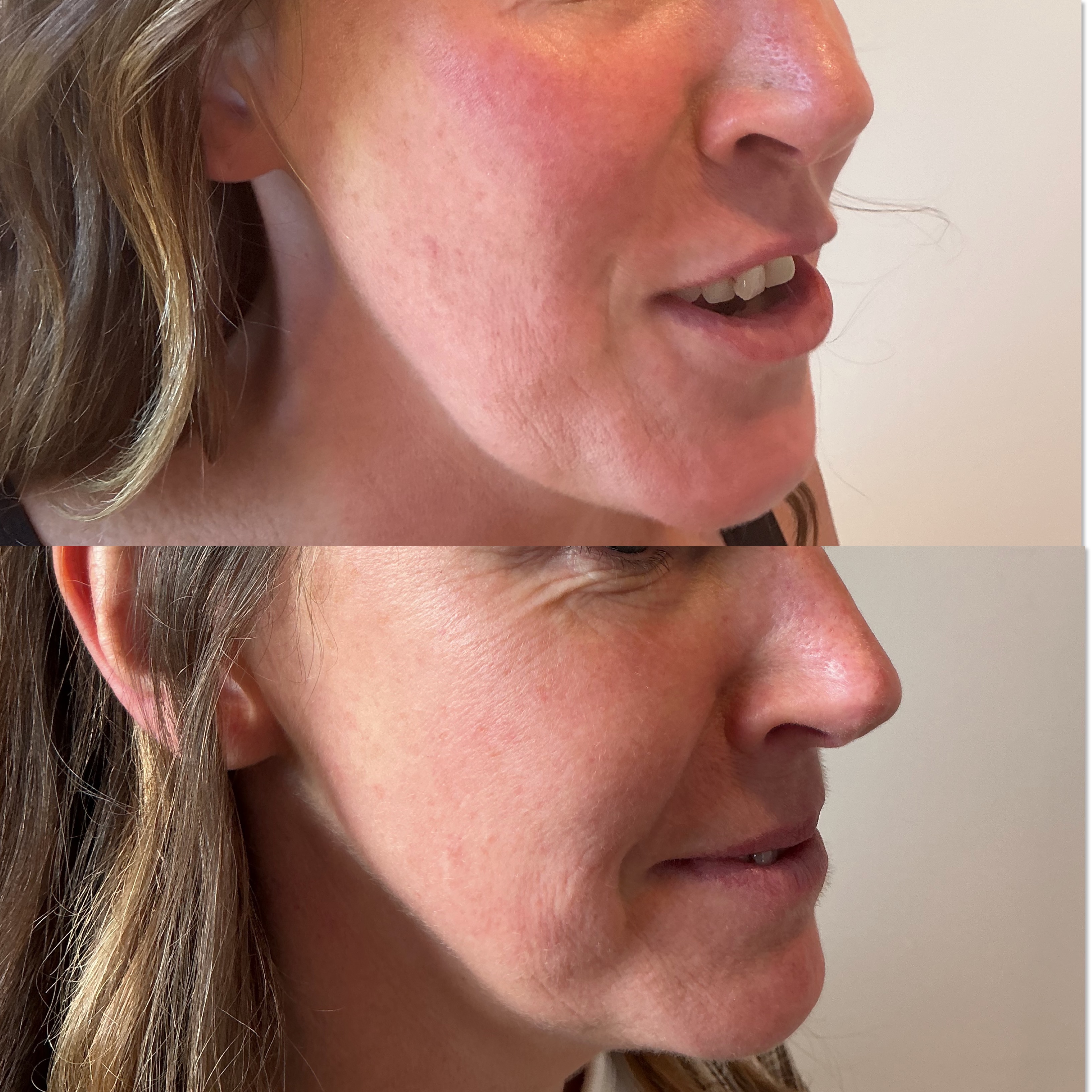 Before and after, real client result at Skinhaven Aesthetics