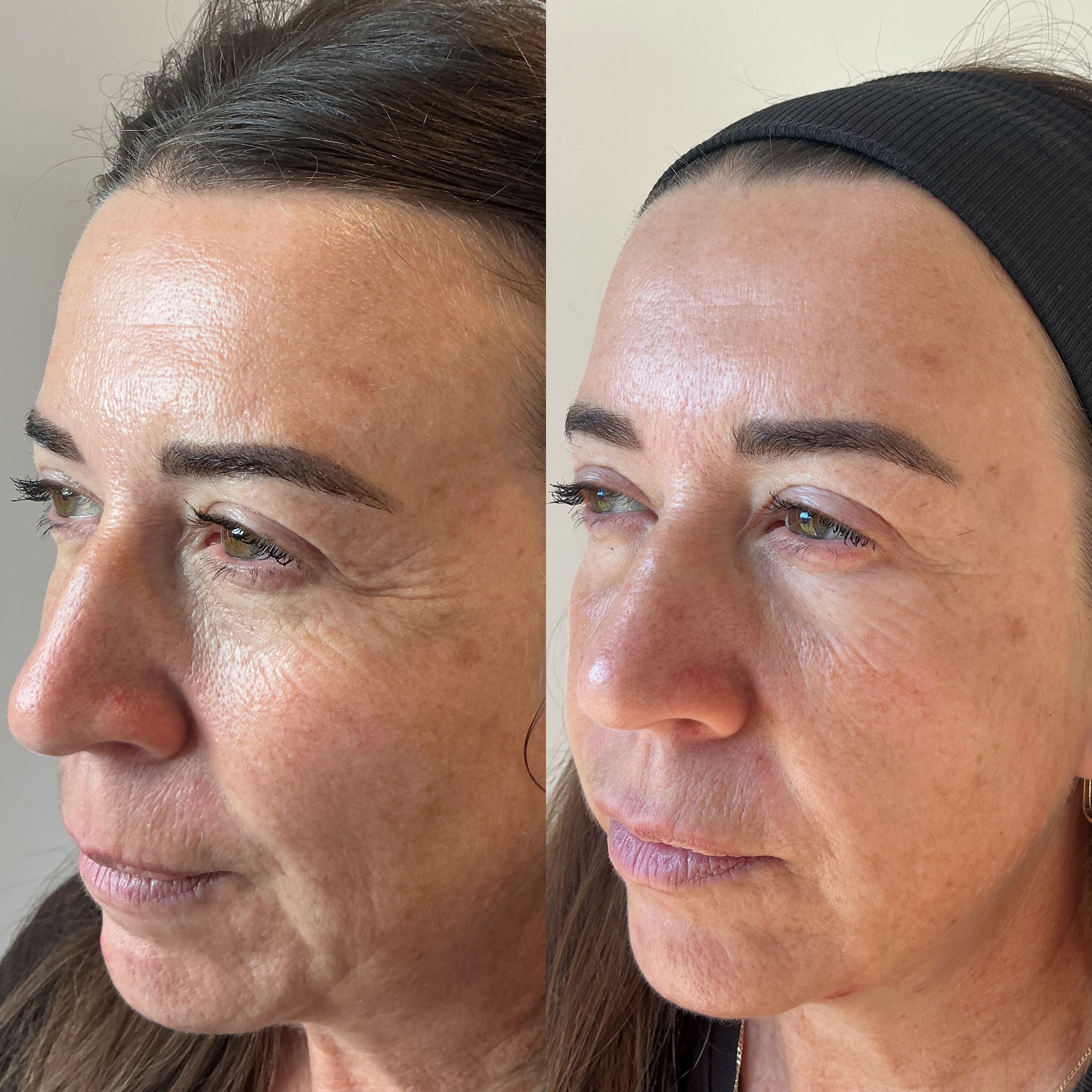 Before and after, real client result at Skinhaven Aesthetics