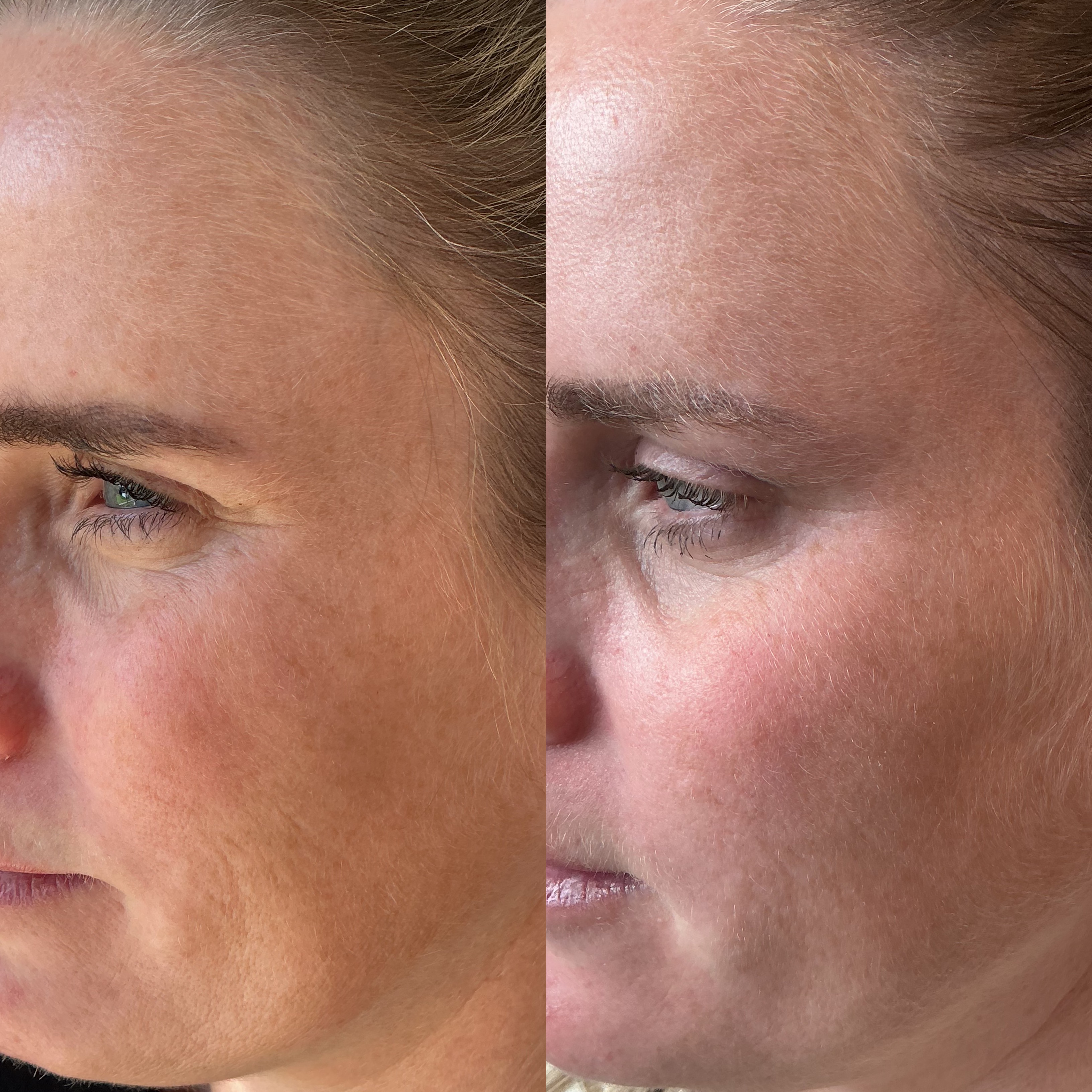 Before and after, real client result at Skinhaven Aesthetics