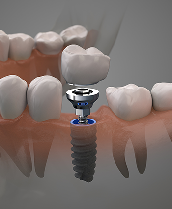 Dental Implants