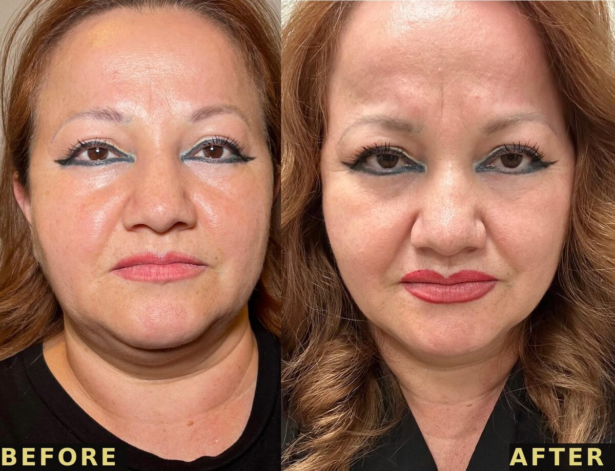 Under chin front view before and after PCDC Lipo Dissolve at Victoria Edward Spa