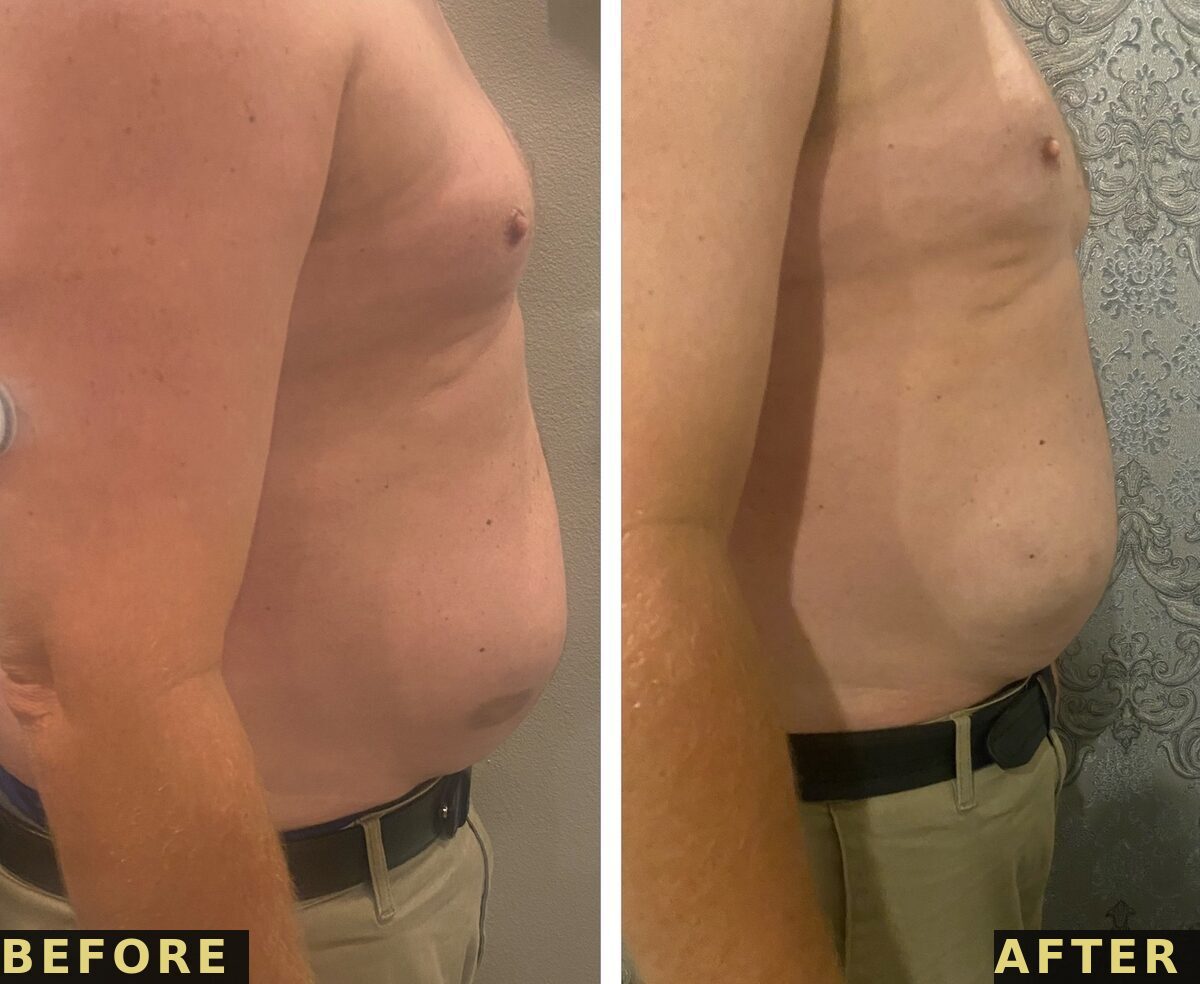 Midsection before and after PCDC Lipo Dissolve at Victoria Edward Spa