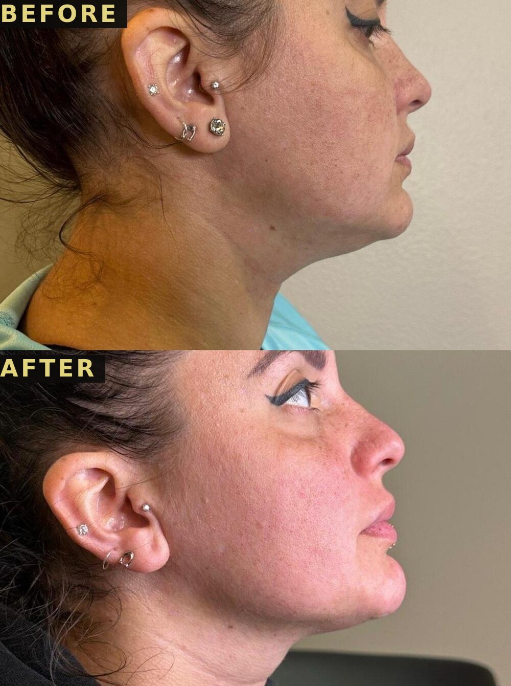 Under chin profile before and after PCDC Lipo Dissolve at Victoria Edward Spa