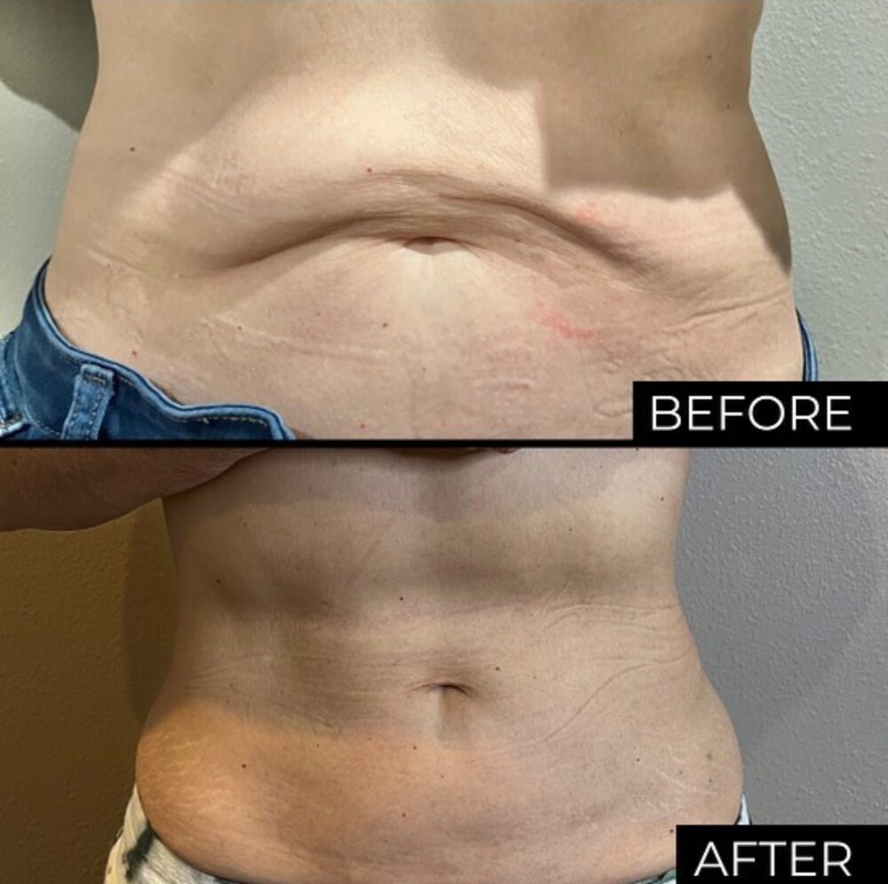 Abdomen before and after PCDC Lipo Dissolve at Victoria Edward Spa
