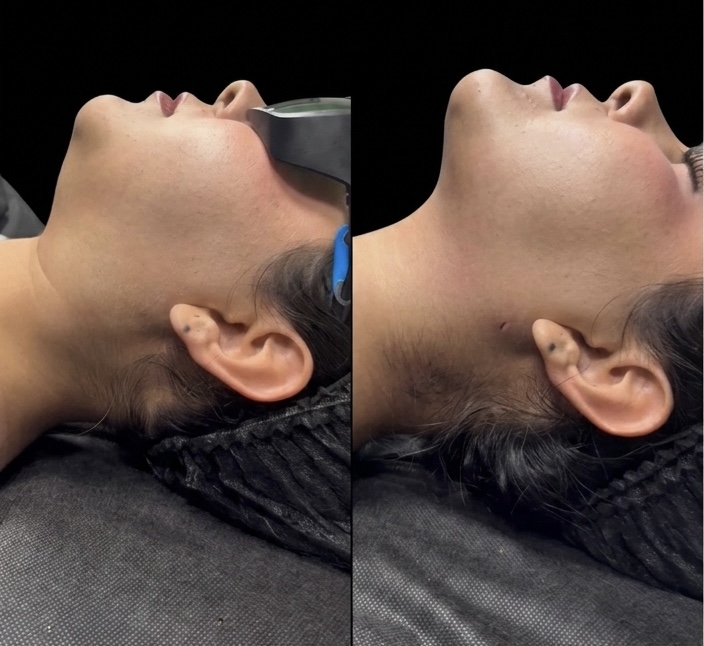 Antes y después Endolyse Tensado Facial