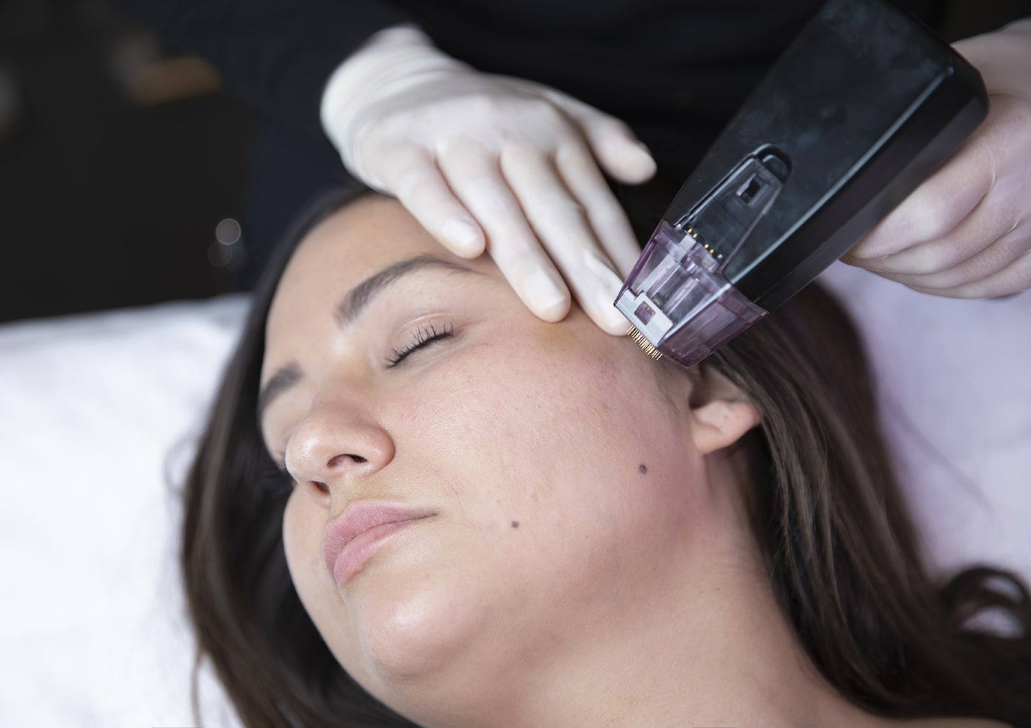 Morpheus8 microneedling procedure at 1st Care Med Spa