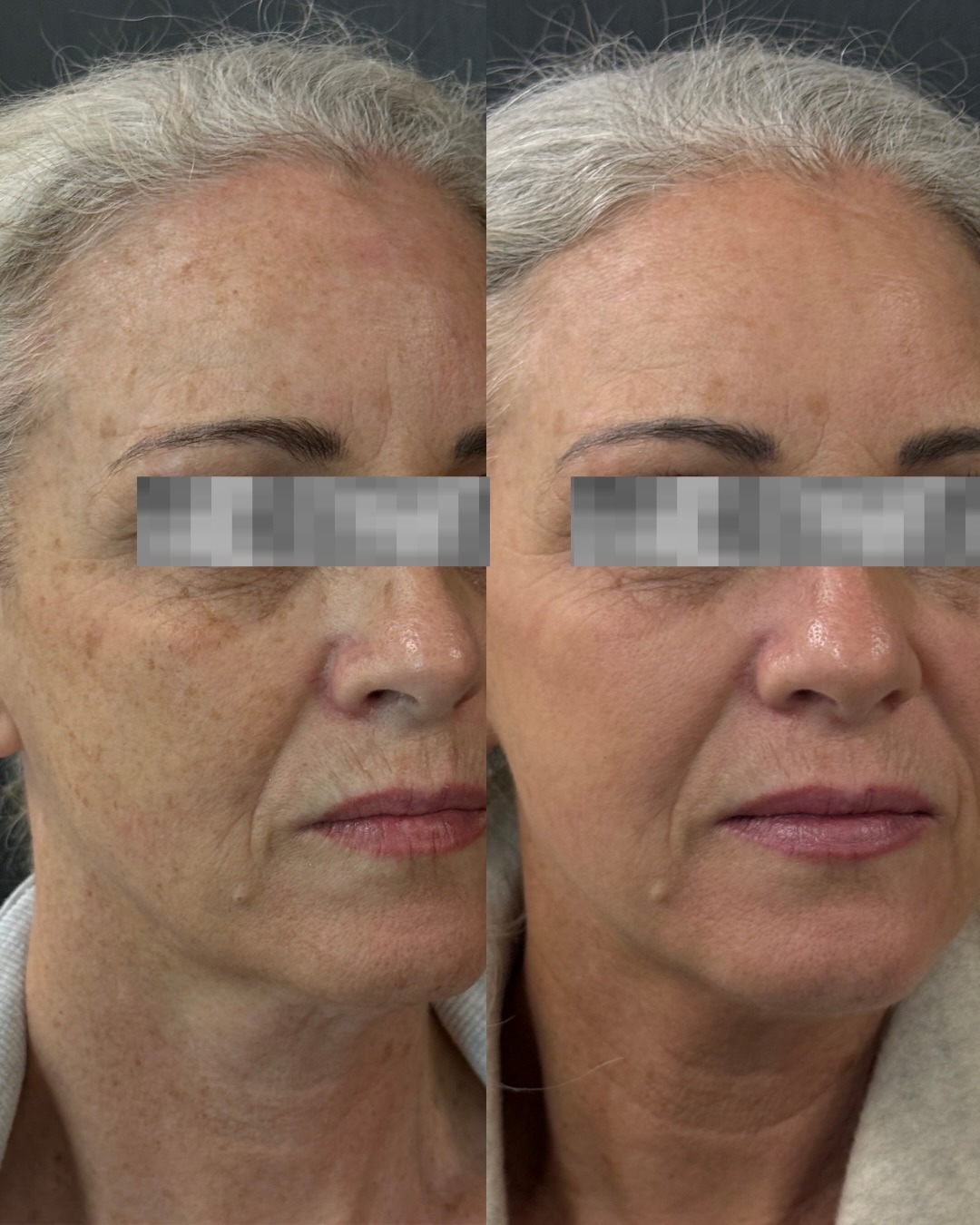 Client skin result before and after treatment at Pearl & Sage