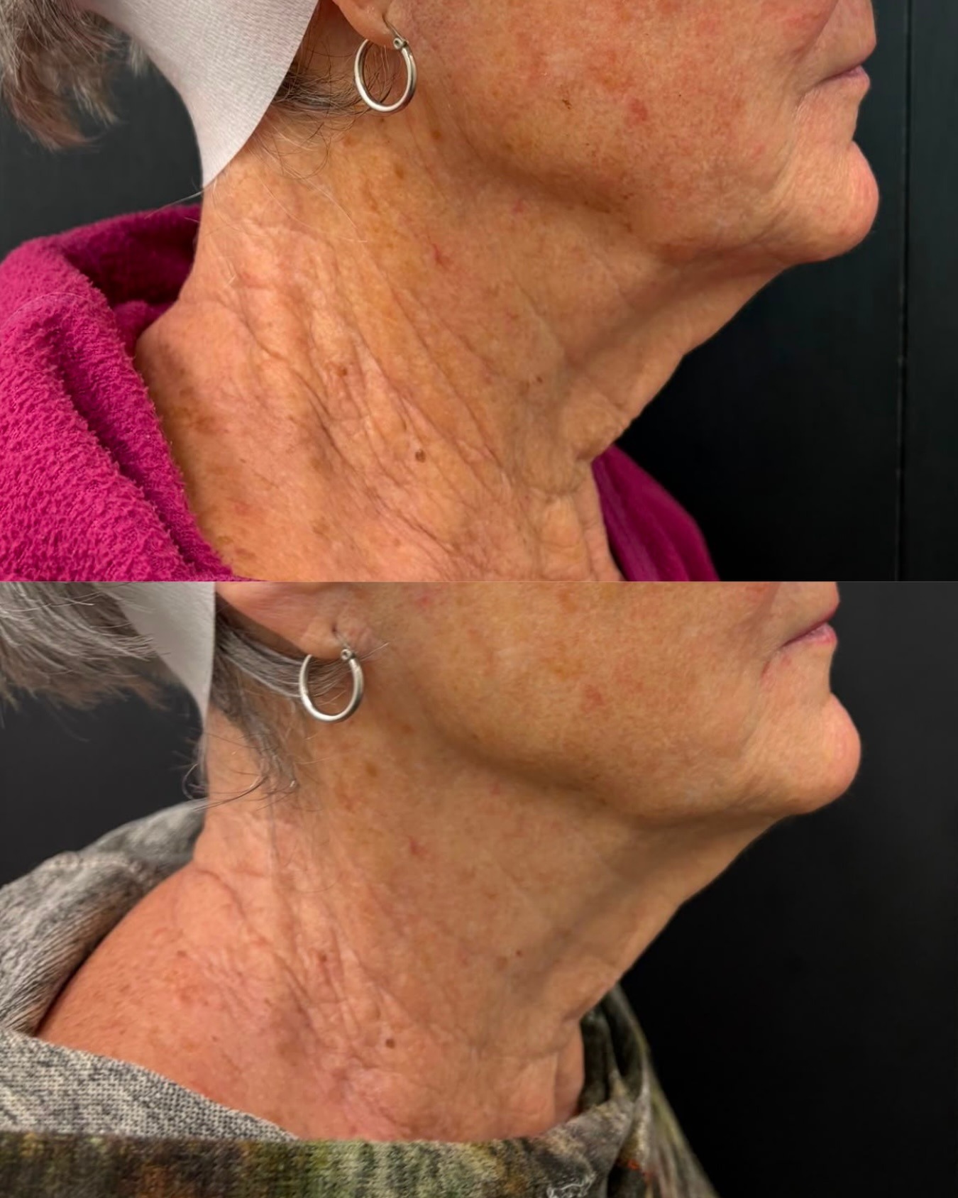 Client skin result before and after treatment at Pearl & Sage