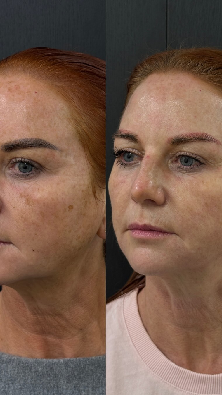 Client skin result before and after treatment at Pearl & Sage