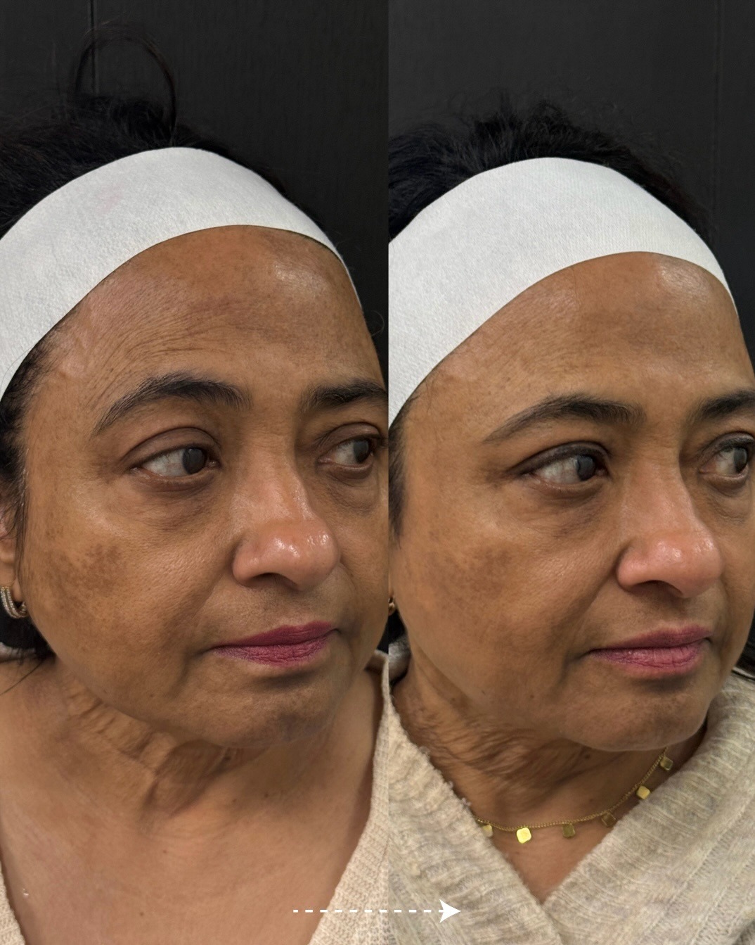 Client skin result before and after treatment at Pearl & Sage