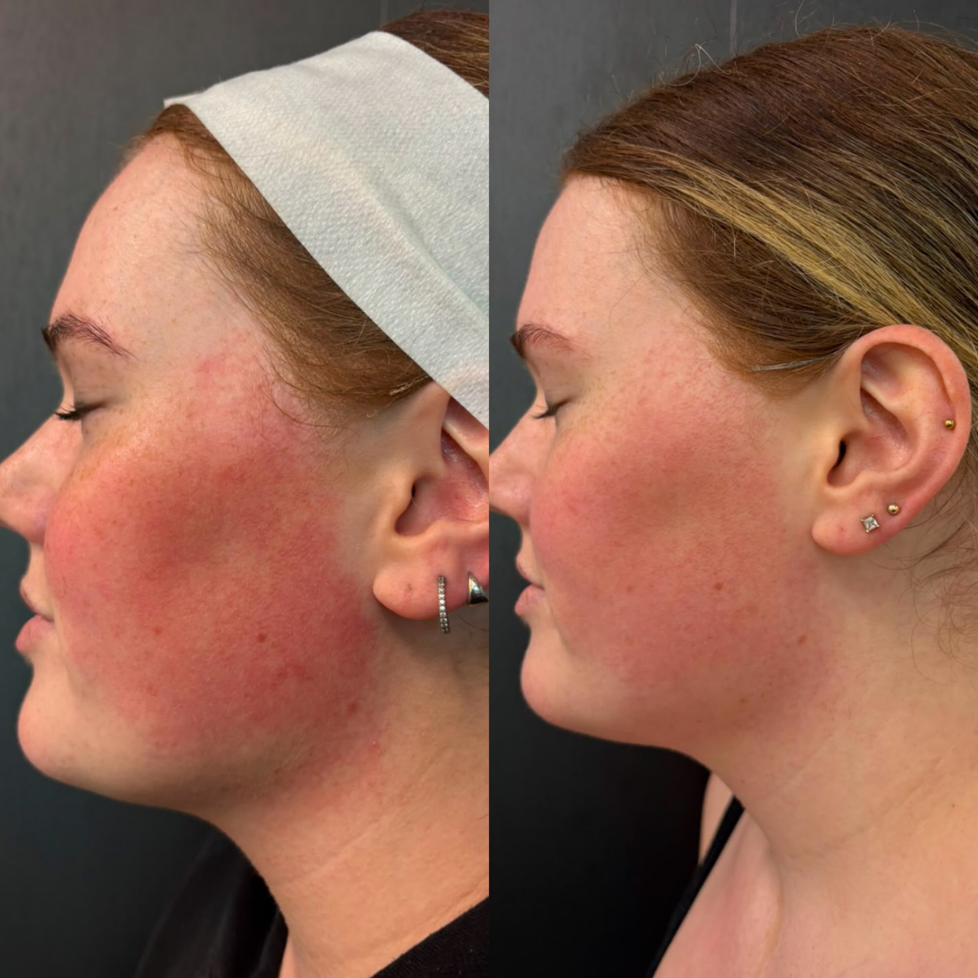 Client skin result before and after treatment at Pearl & Sage