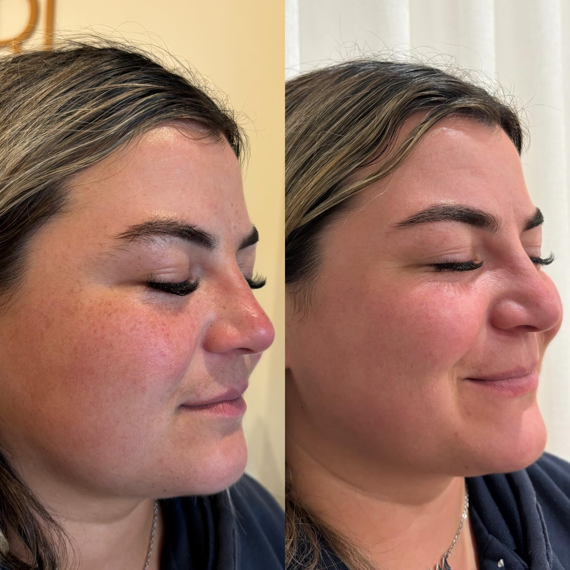 Client skin result before and after treatment at Pearl & Sage