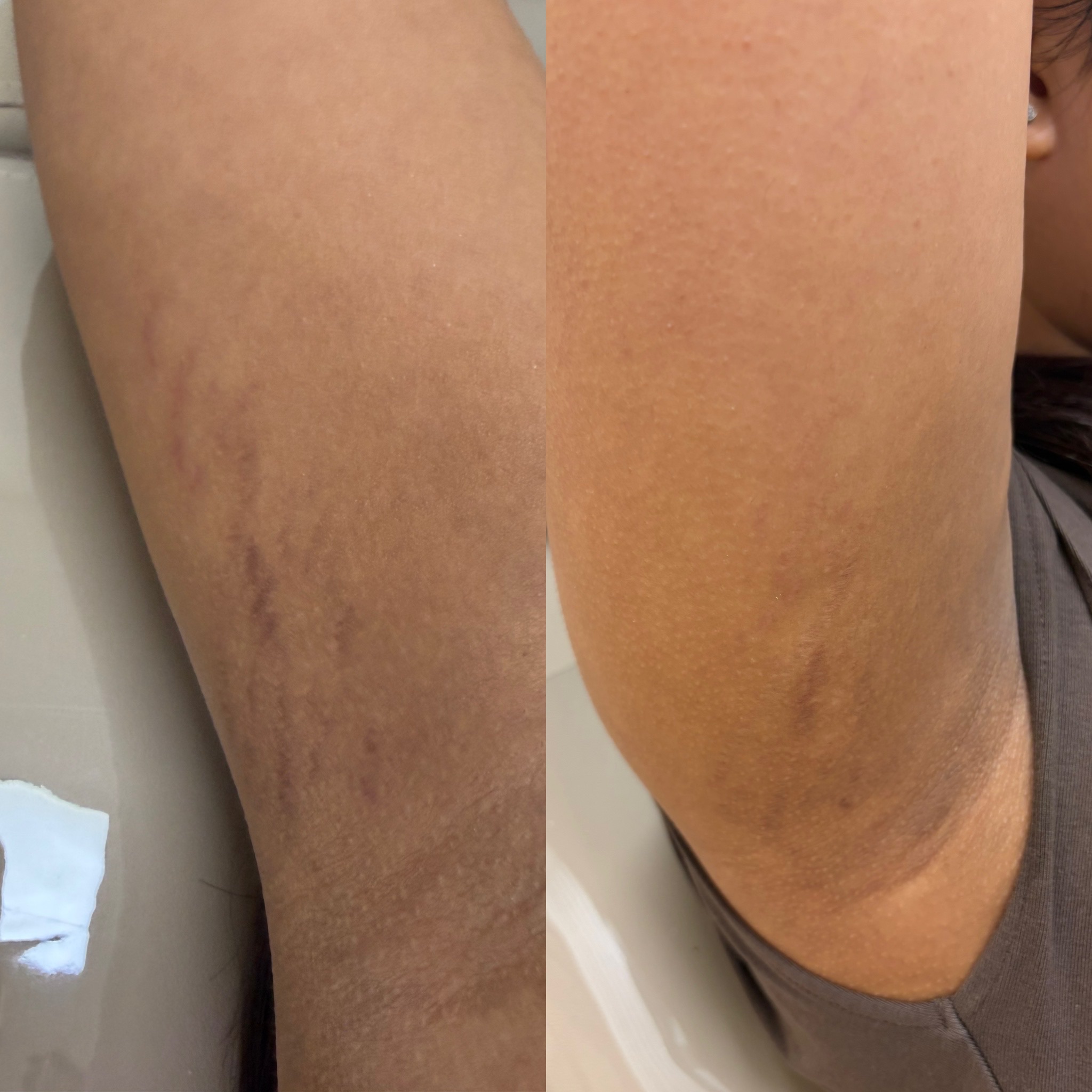 Client skin result before and after treatment at Pearl & Sage