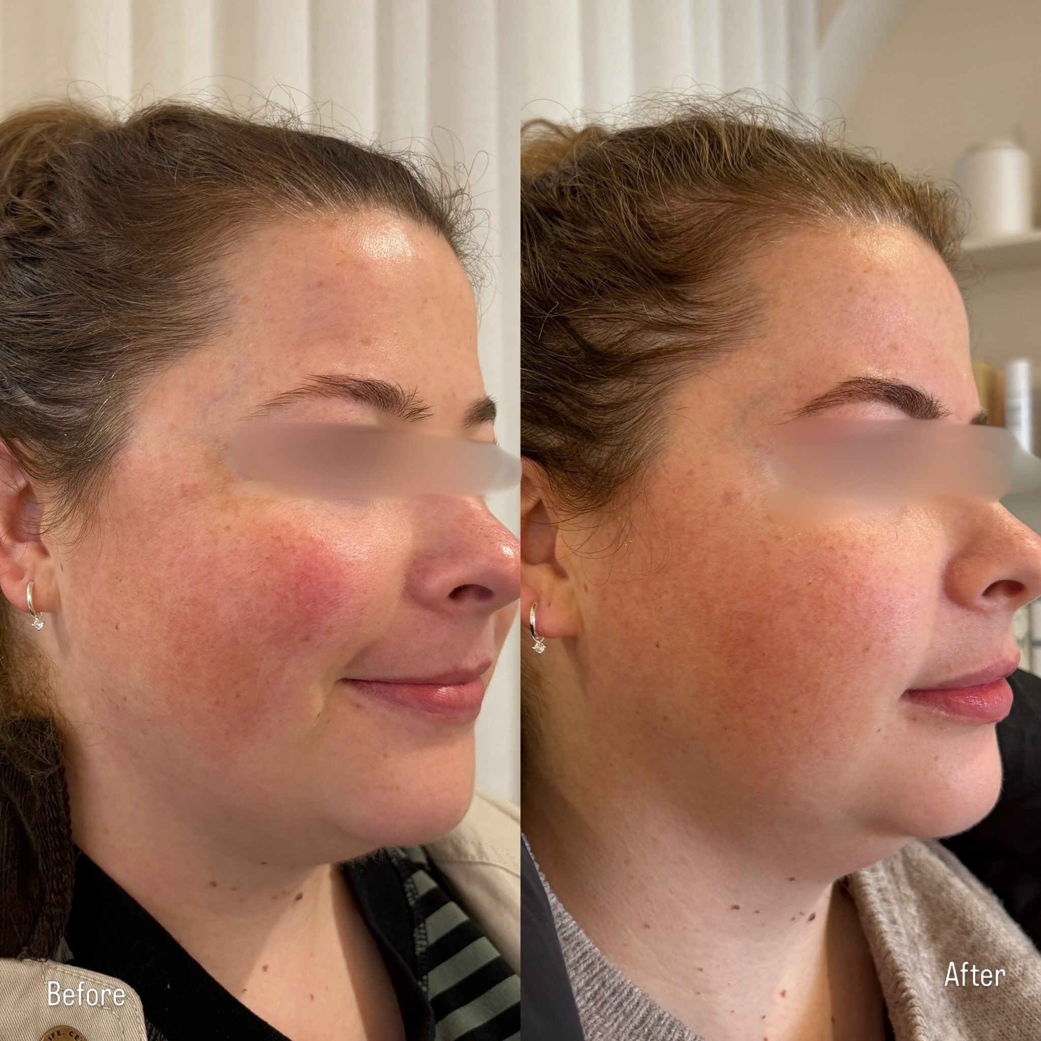 Client skin result before and after treatment at Pearl & Sage