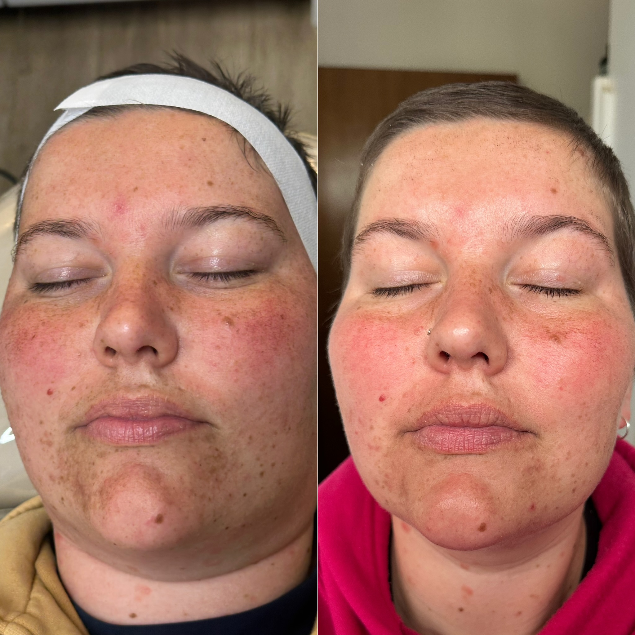 Client skin result before and after treatment at Pearl & Sage