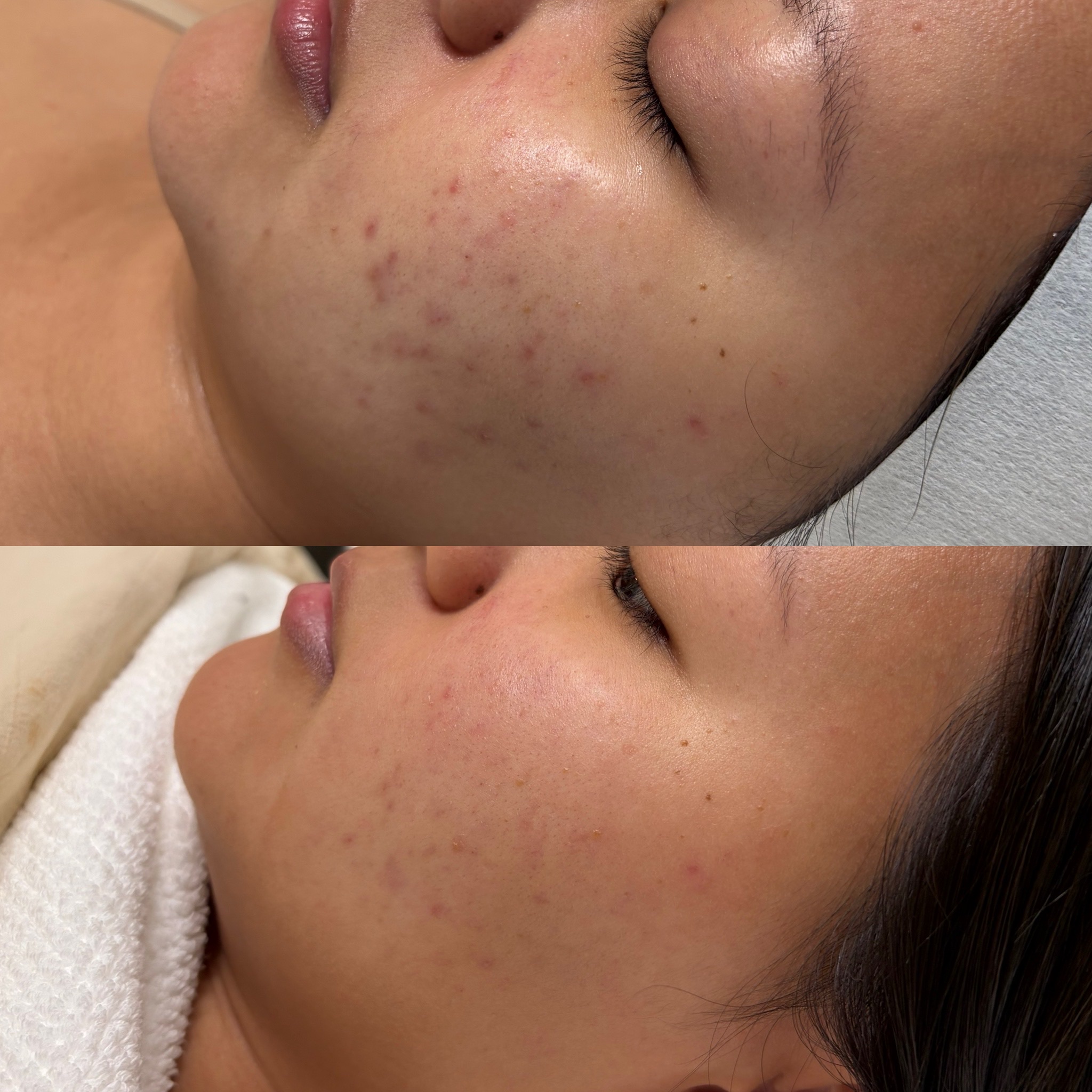 Client skin result before and after treatment at Pearl & Sage