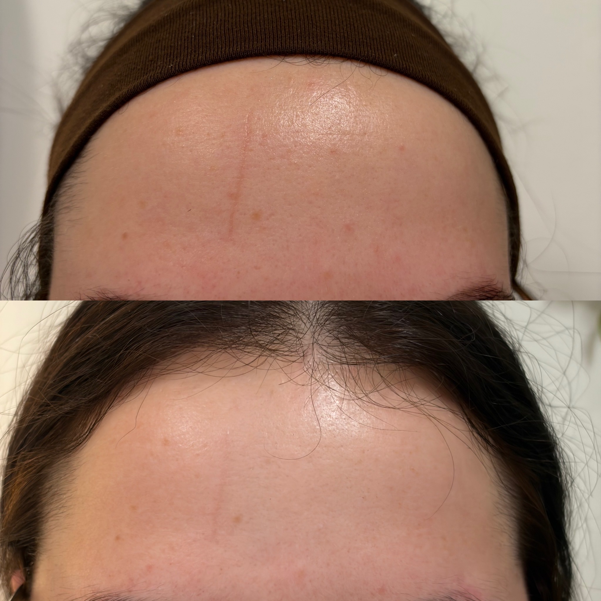 Client skin result before and after treatment at Pearl & Sage